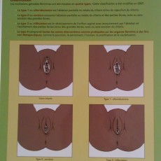 Board depicting the different types of Female Genital Mutilation (FGM) + technique of desinfibulation.